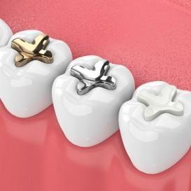 Tooth Coloured Fillings